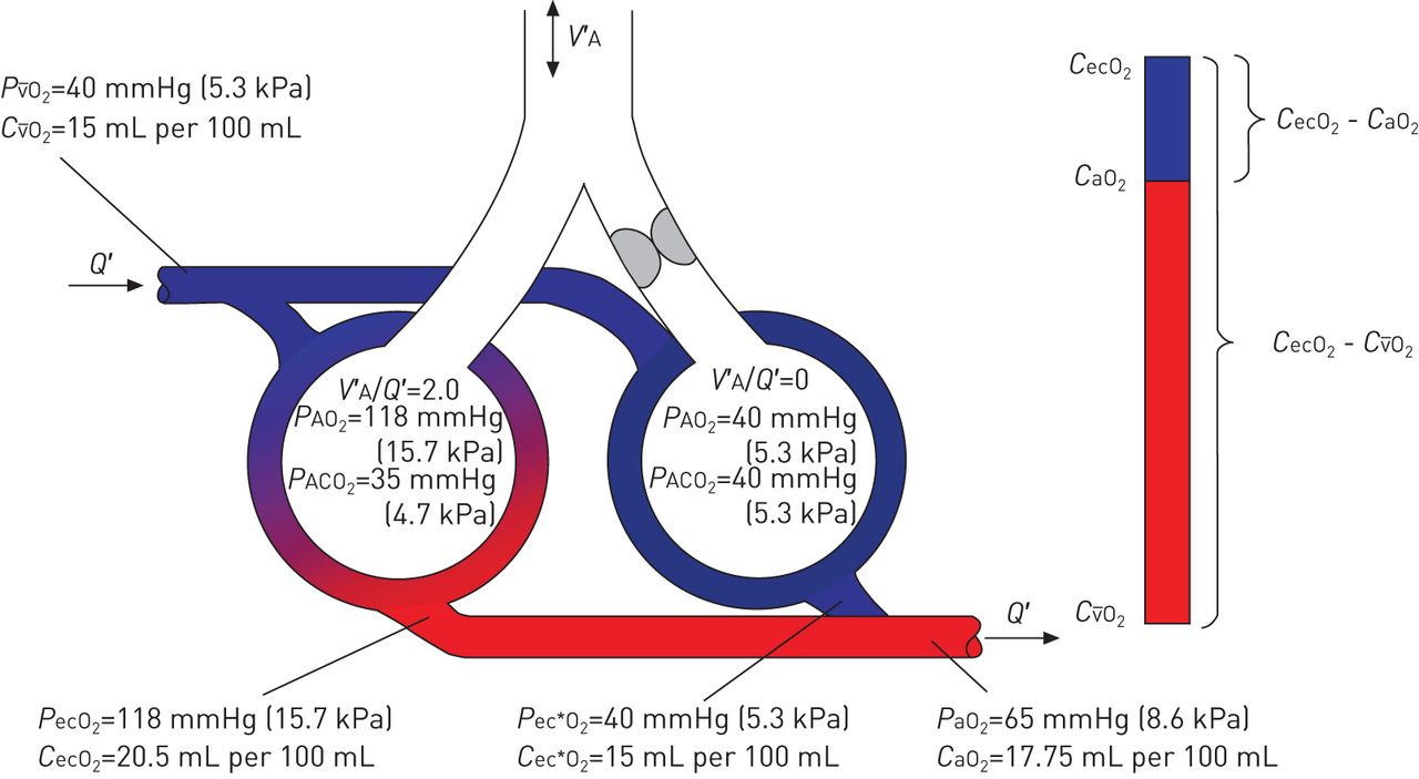 Gas exchange and ventilation–perfusion relationships in the lung ...