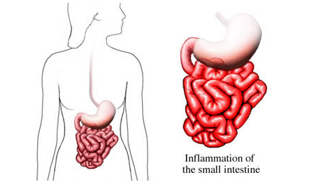 Holistically Curing a Gut Yeast Infection Safely from Home