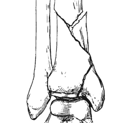 body line drawing