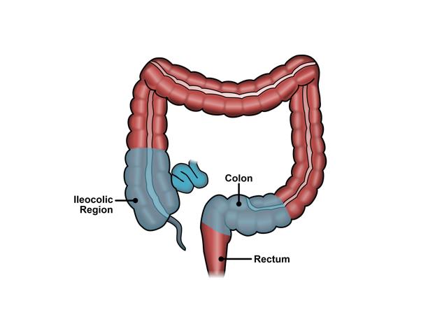 Crohn's Disease Expanded Version | ASCRS