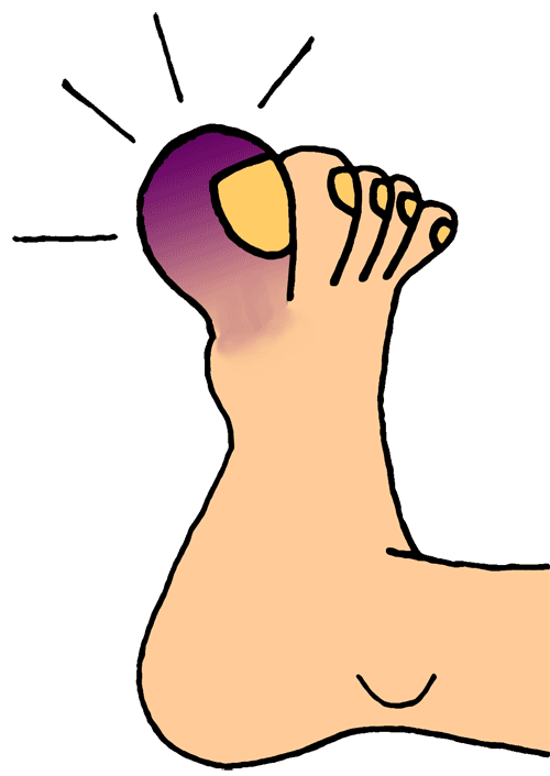 Broken Foot Cartoon - ClipArt Best