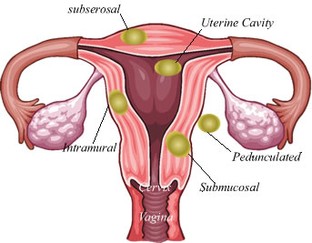 Uterine Factors St. Luke's Roosevelt - Infertility Treatment ...