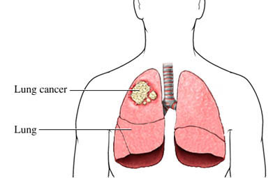 Lung Cancer — UVA Health