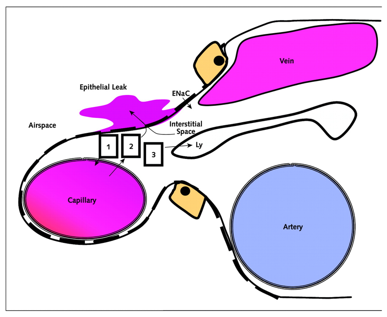 Annals of Internal Medicine | The Acute Respiratory Distress Syndrome