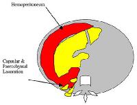 Liver Trauma Imaging