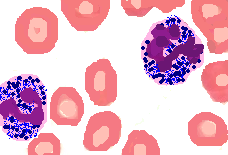 Morphologic Alterations in Neutrophils - Dr Sampurna Roy MD