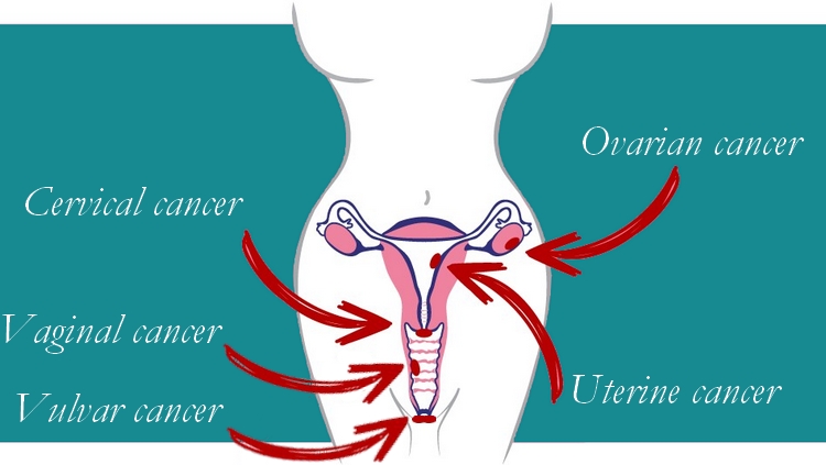 Gynecological Cancer Awareness – Female Reproductive Cancers