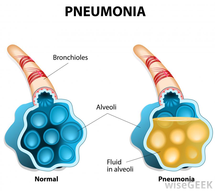 What is a Primary Infection? (with pictures)