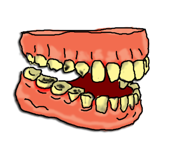 Clip Art Mouth With Cavities Clipart