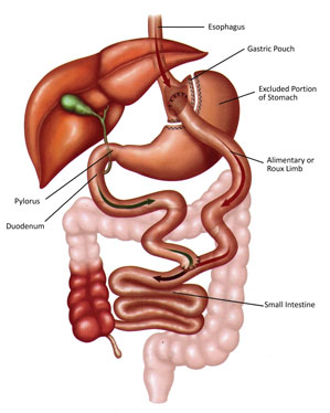 Surgical Options - Memorial Bariatric Surgery Center