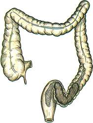 Fecal impaction | definition of fecal impaction by Medical dictionary