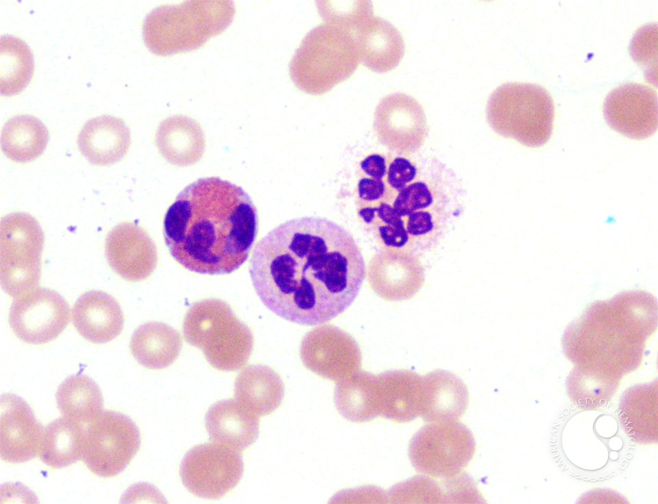 Hypersegmented Neutrophil - 2.