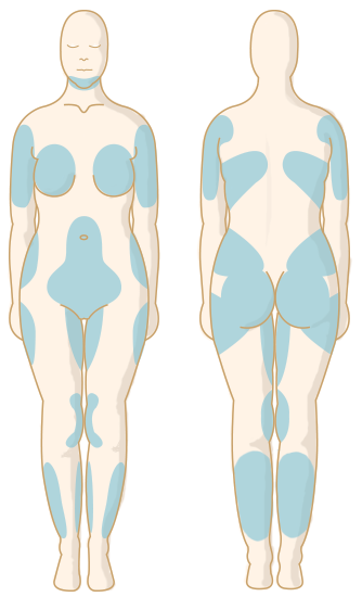 Which body areas can be treated with SmartLipo ?