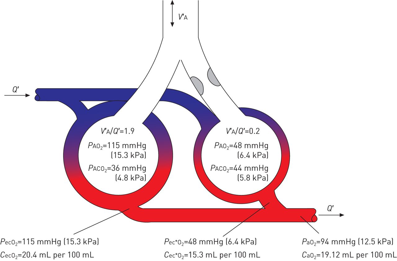 Gas exchange and ventilation–perfusion relationships in the lung ...