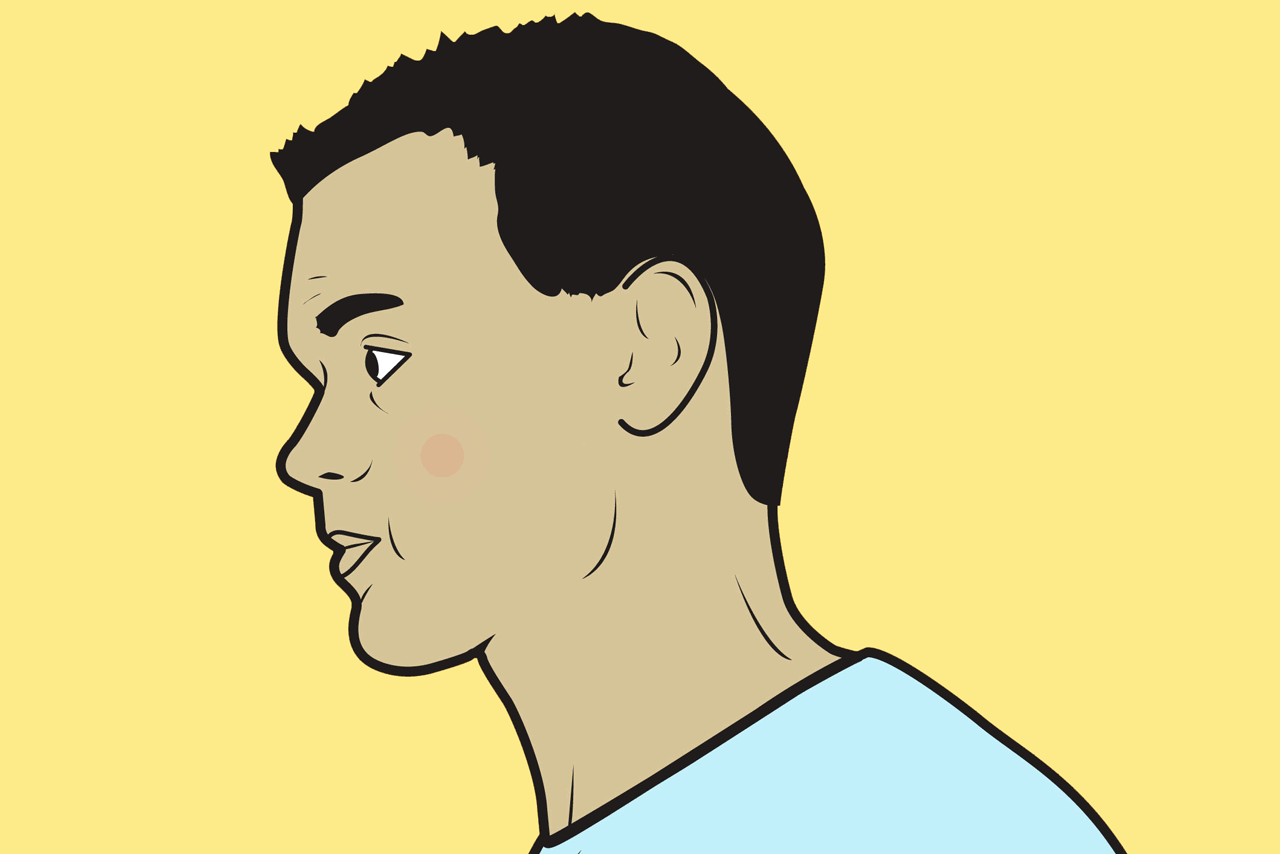 How to Pop a Pimple the Smart Way