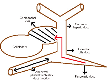 Type VI choledochal cyst revisited