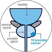 Localised prostate cancer | Prostate Cancer UK
