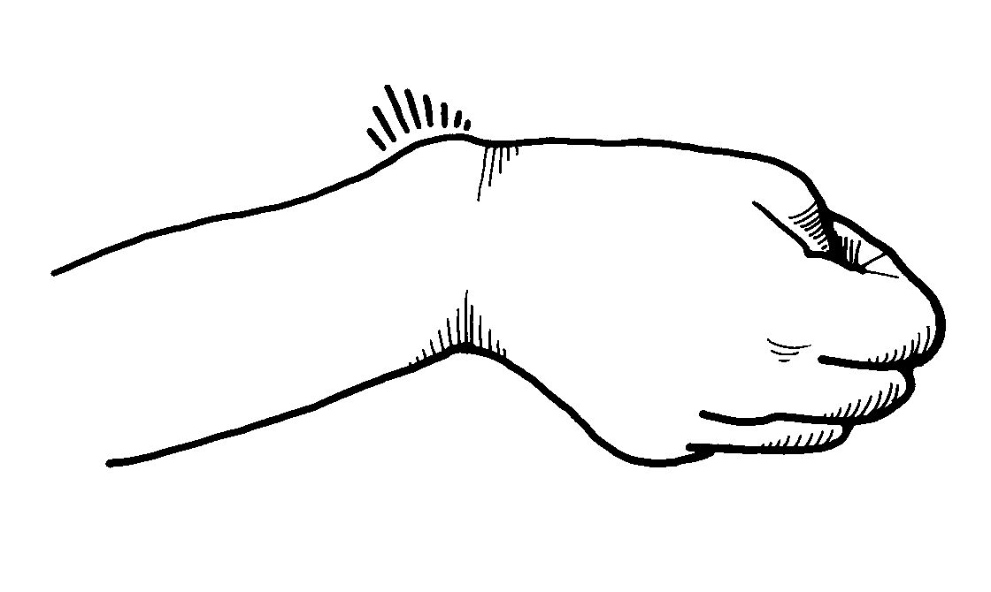 The Milwaukee Hand Center Dr. Greg Watchmaker